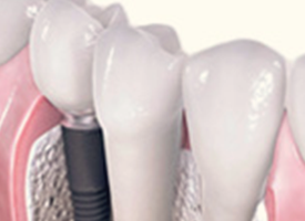 Implant Crowns